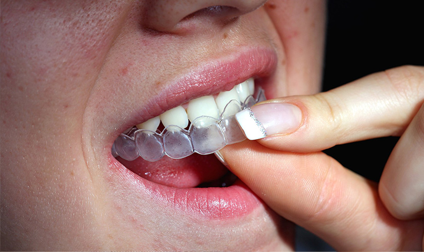 Instruction on the effective way to whitening teeth using trays
