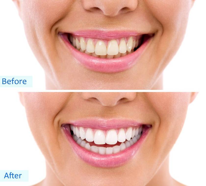 Teeth before and after whitening