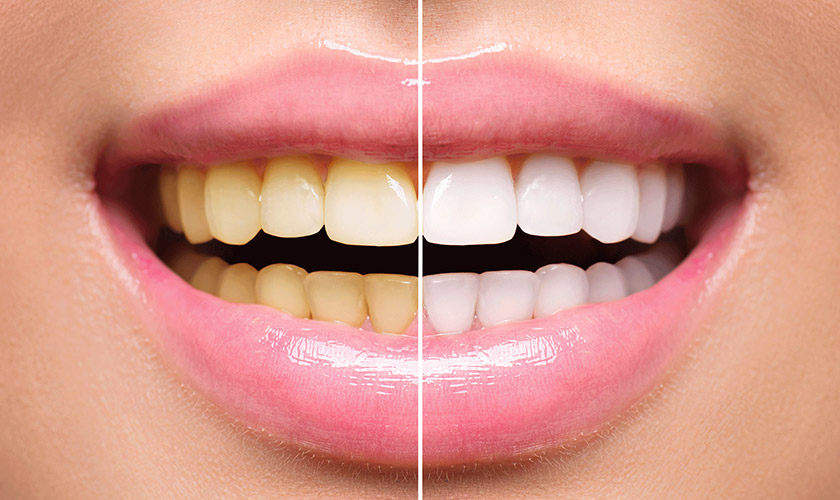 Teeth whitening