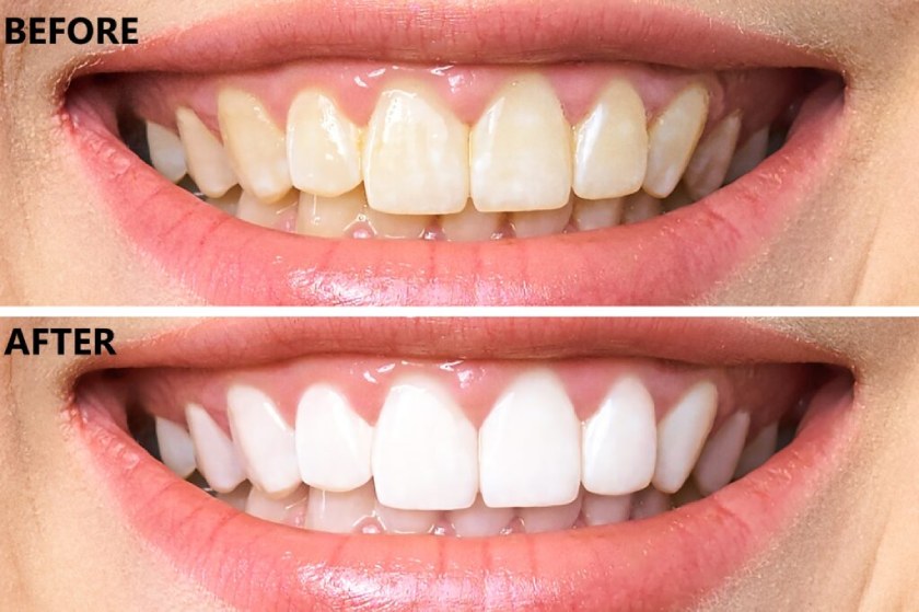 Răng trắng sáng dài lâu sau khi tẩy trắng răng với công nghệ Laser Whitening Răng trắng sáng dài lâu sau khi tẩy trắng răng với công nghệ Laser Whitening