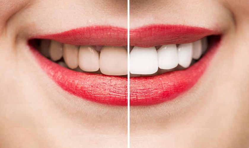 Whitening helps to bring bright white teeth