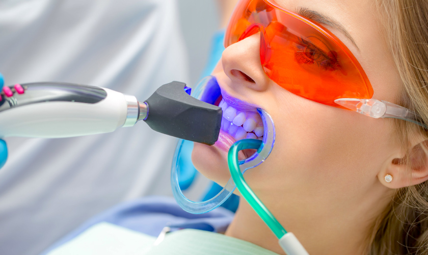 Laser Whitening is considered to be a superfast whitening method by experts