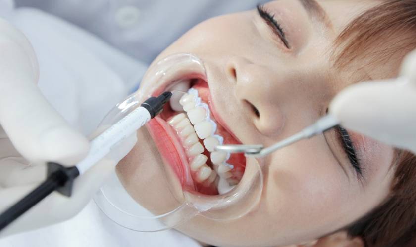 teeth whitening