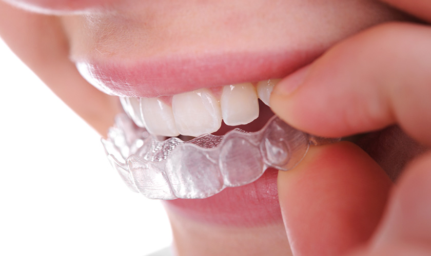 Wear whitening trays to protect your gums when whitening