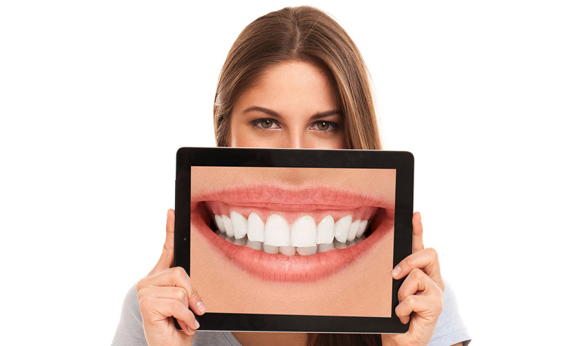 Teeth Whitening Cost