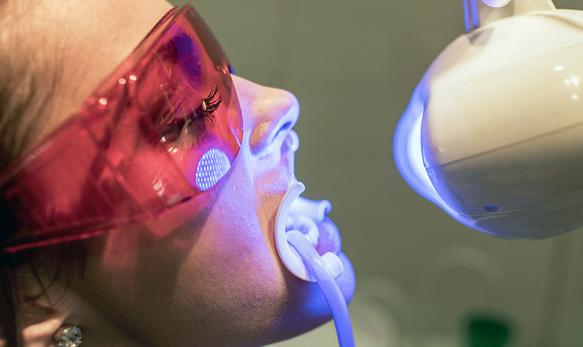 Laser Whitening Technique
