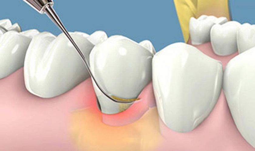 Remove tarnish before whitening