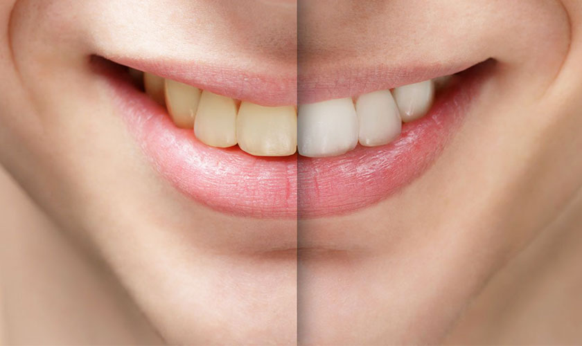 The dark teeth treatment