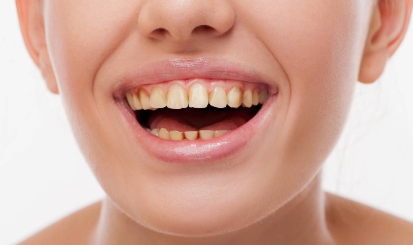 Tooth discoloration: causes, preventions and treatments