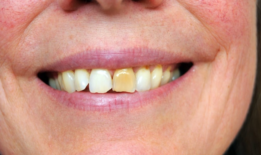 Causes of tooth discoloration