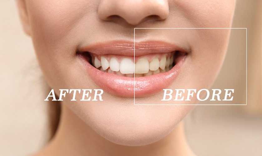 What treatment options are available to whiten teeth?