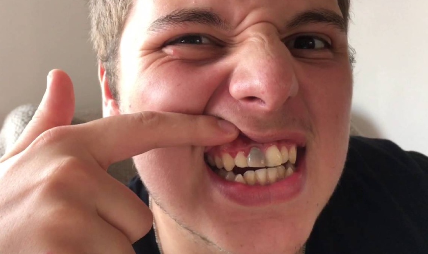 Why do teeth turn black?