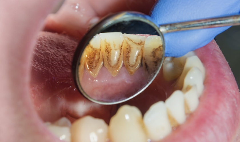 Why do teeth turn black?