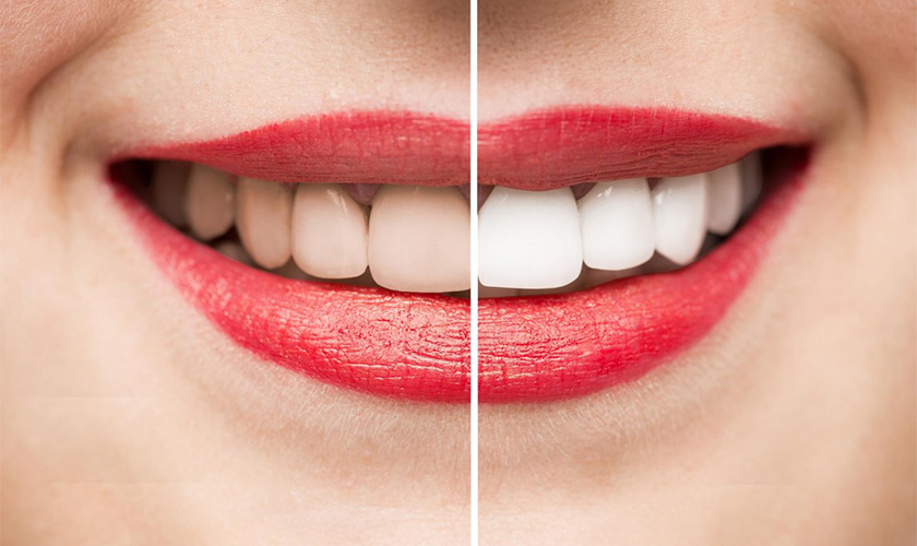 Why do teeth turn black?