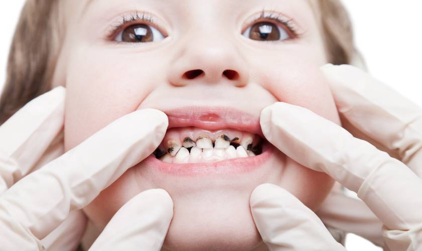 What is the main cause of cavities