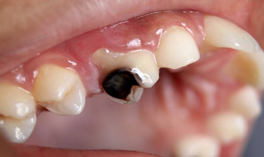 What is the main cause of cavities