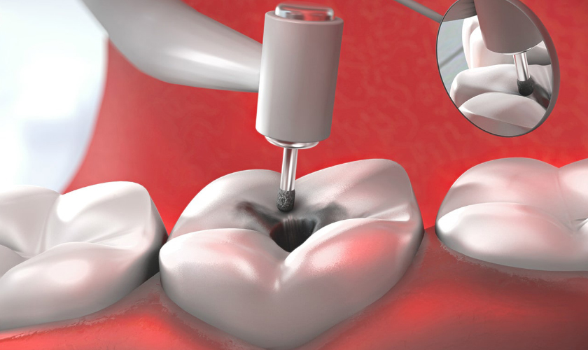Tooth Decay - Causes and Prevention