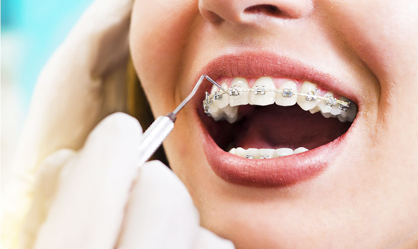 Preventing tooth decay with braces