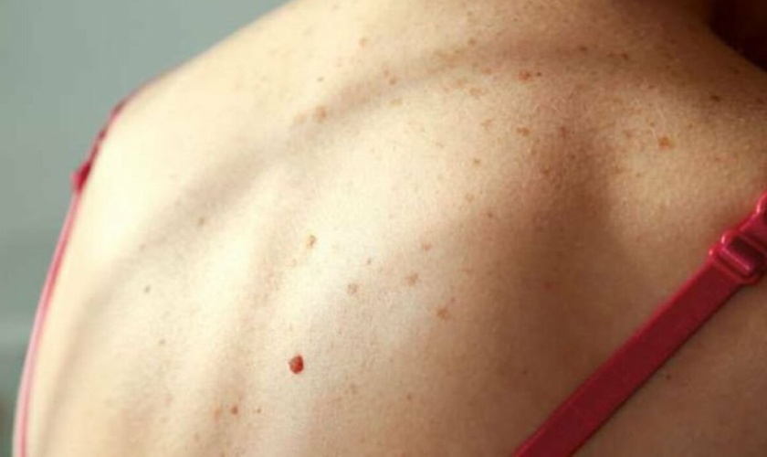 An example of a mole that warns of skin cancer: Unusually large mole, the border is gradually spreading around