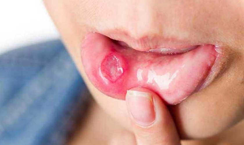 With wounds in the mouth that take a long time to heal, for example, canker sores are spreading, be careful and see a doctor right away