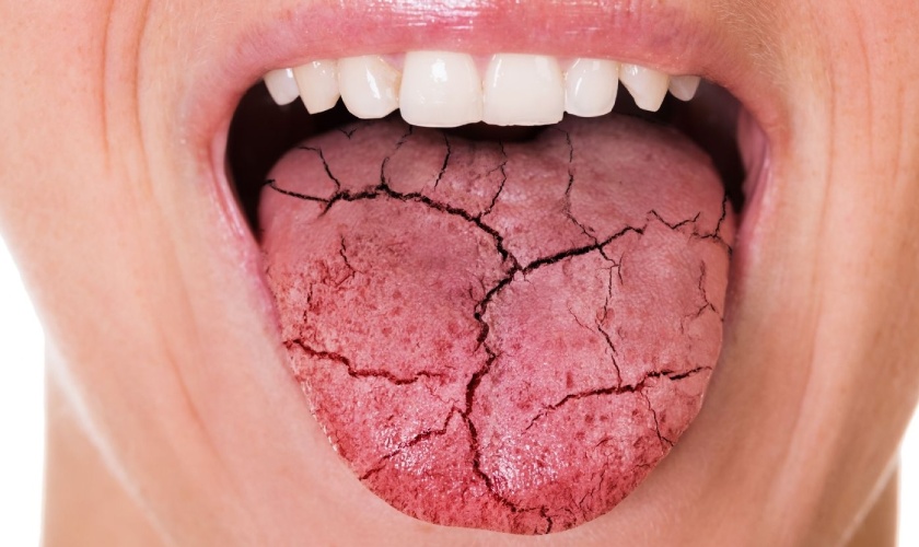 Dry mouth