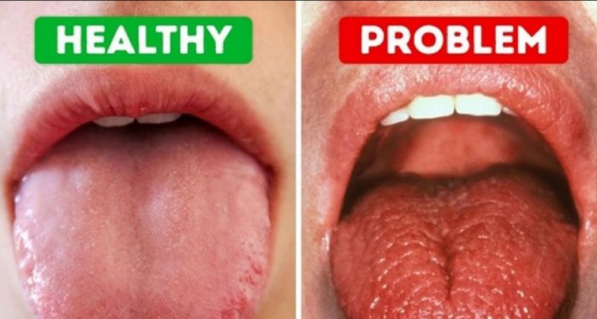 dry mouth