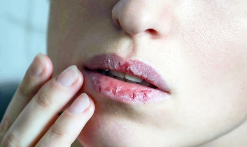 dry mouth