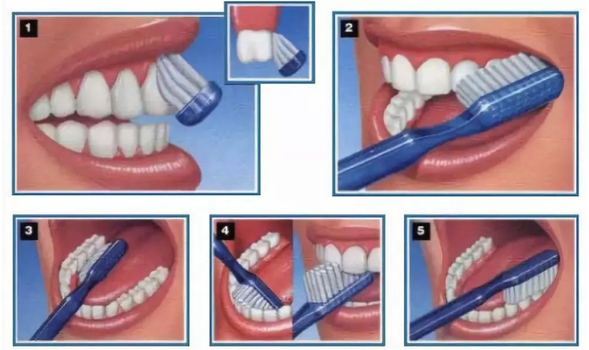 Brushing properly will help prevent tooth wear