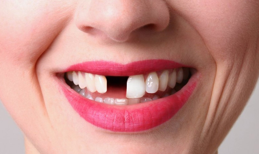Tooth extractions — particularly of front teeth — may negatively affect your appearance