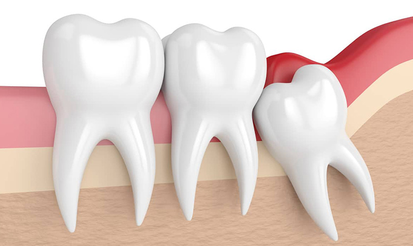 Should I have my wisdom teeth removed?