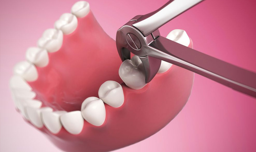 Tooth extraction aftercare
