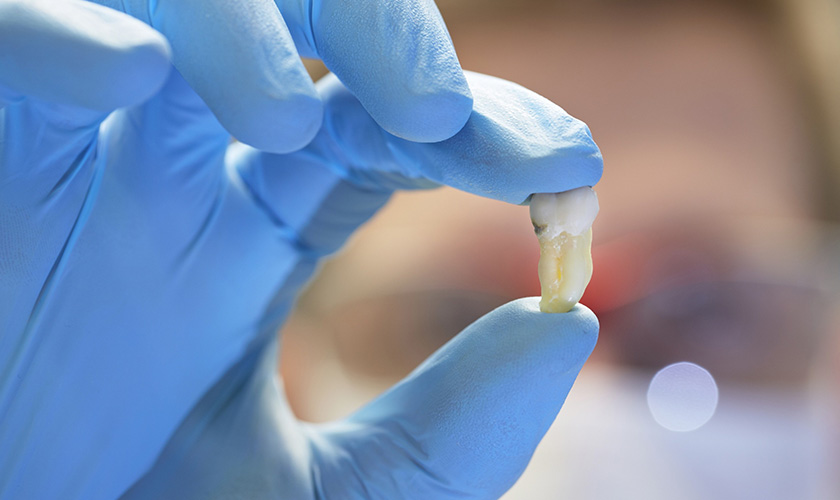 Wisdom teeth removal and its procedure
