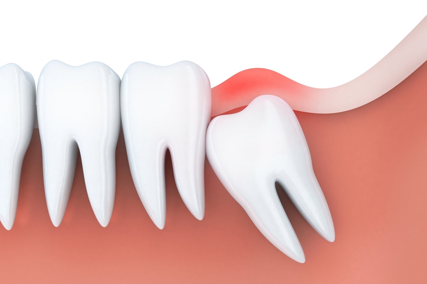 Wisdom teeth removal is difficult and complex because it can grow abnormally