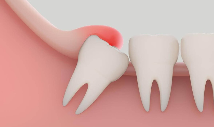 Wisdom teeth is covered by gums
