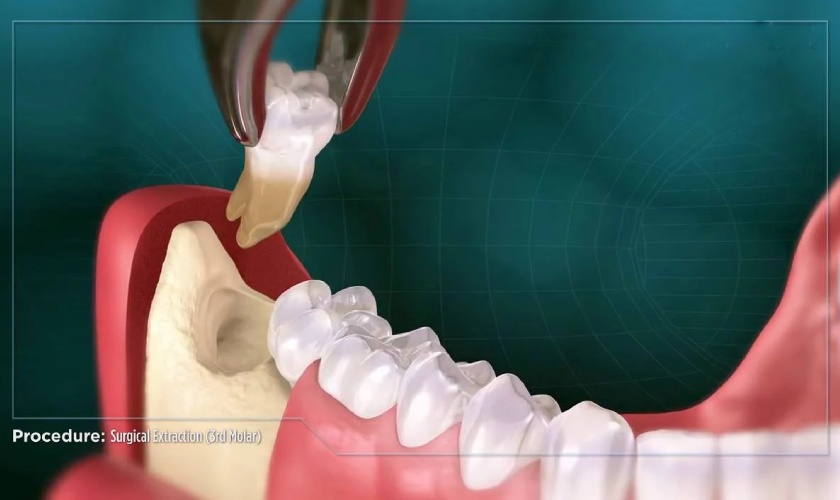 Wisdom teeth that are misaligned should be extracted