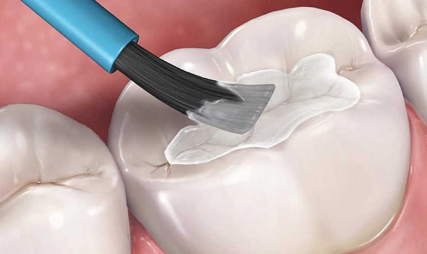Why Get Sealants?