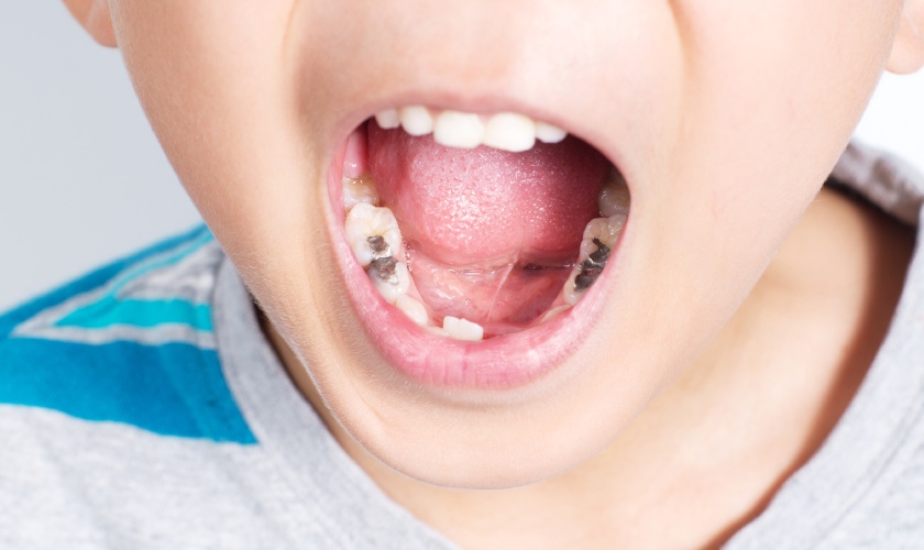 Who Should Get Sealants?