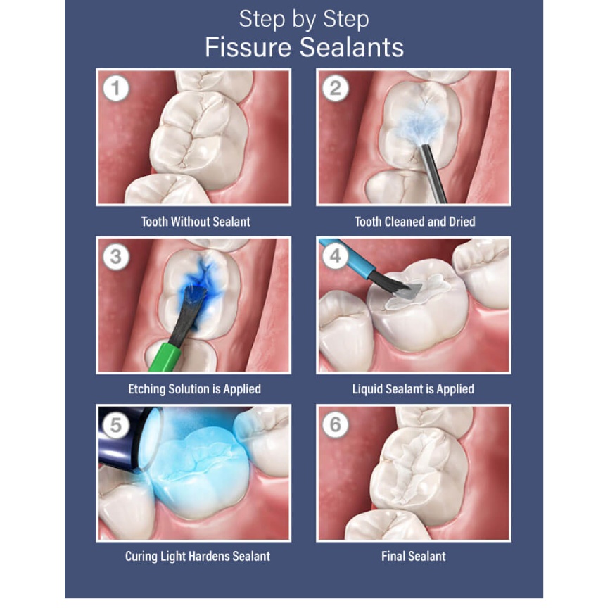 How Are Sealants Applied?