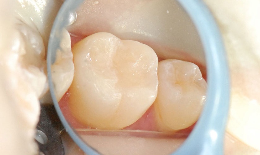 Can cosmetic fillings become discolored?