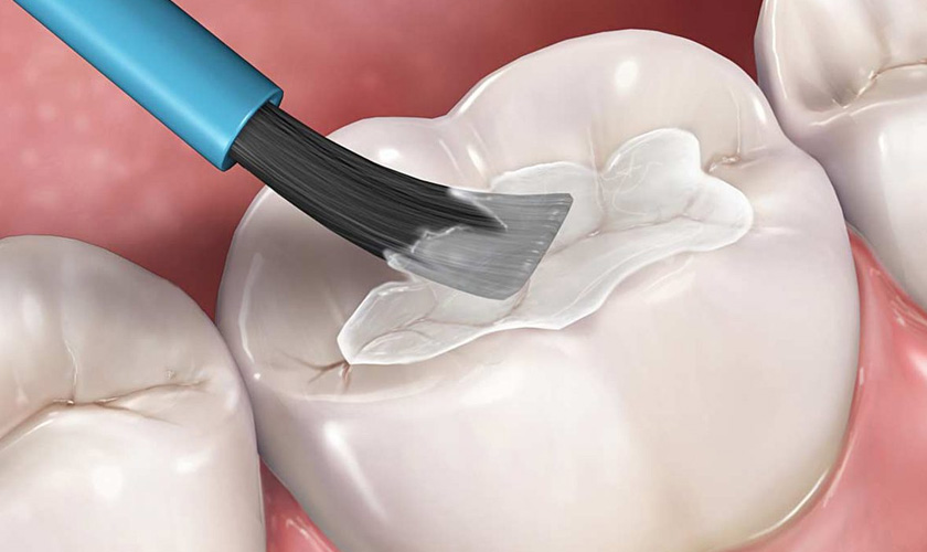 Can cosmetic fillings become discolored?
