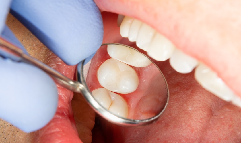 Dental sealants prevent cavities