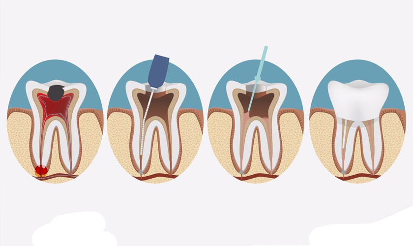 Dental filling is an effective solution to tooth decay