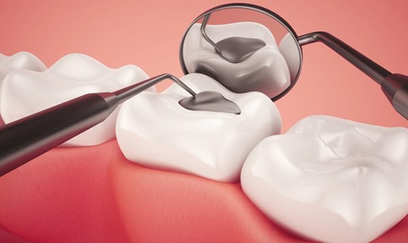 Warranty policy and condition for dental filling