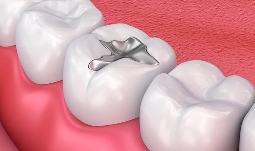 What is Amalgam filling