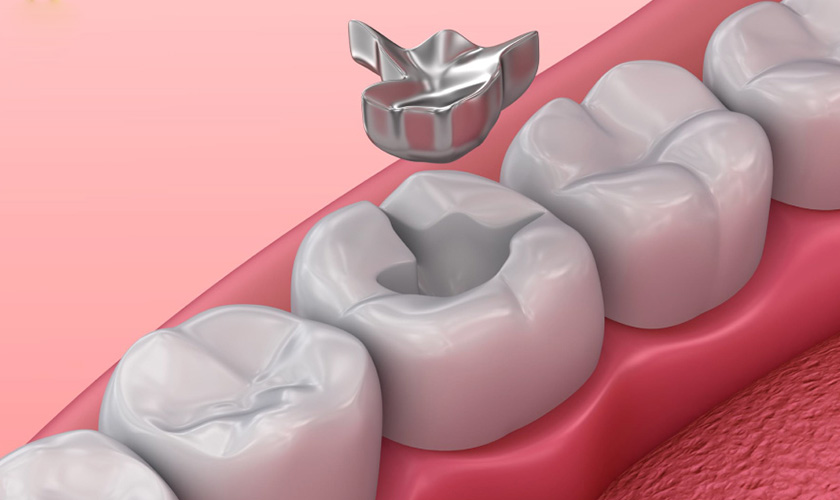 What is Amalgam filling