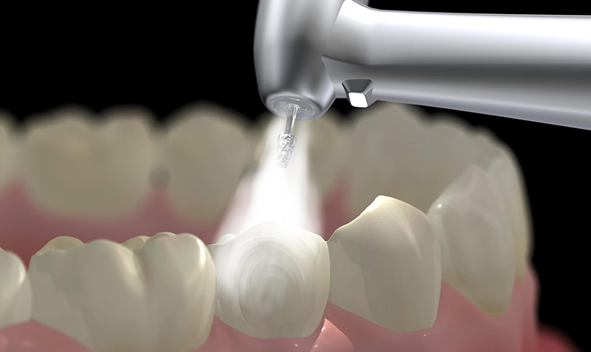 Why does teeth sensitivity occur after filling?