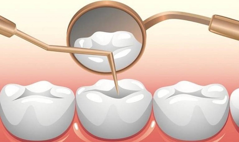 4. Lợi ích của việc trám răng composite