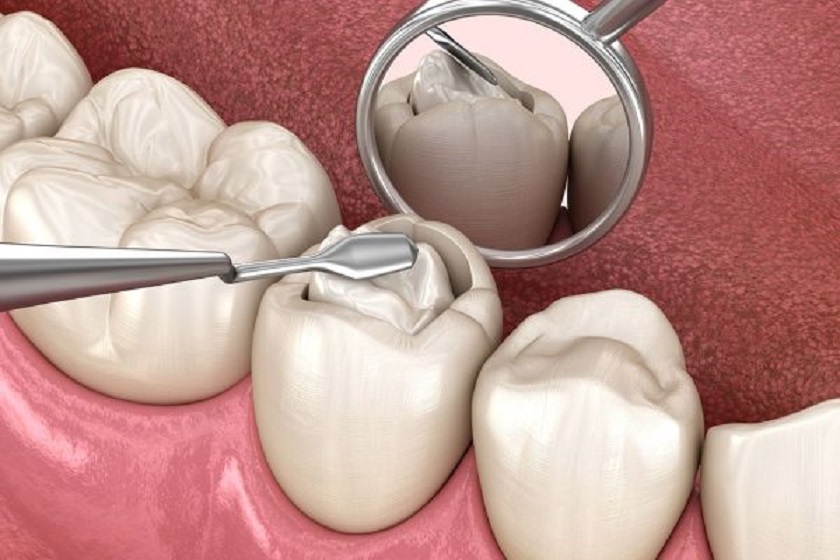 Kỹ thuật trám Tooth Kỹ thuật trám Tooth