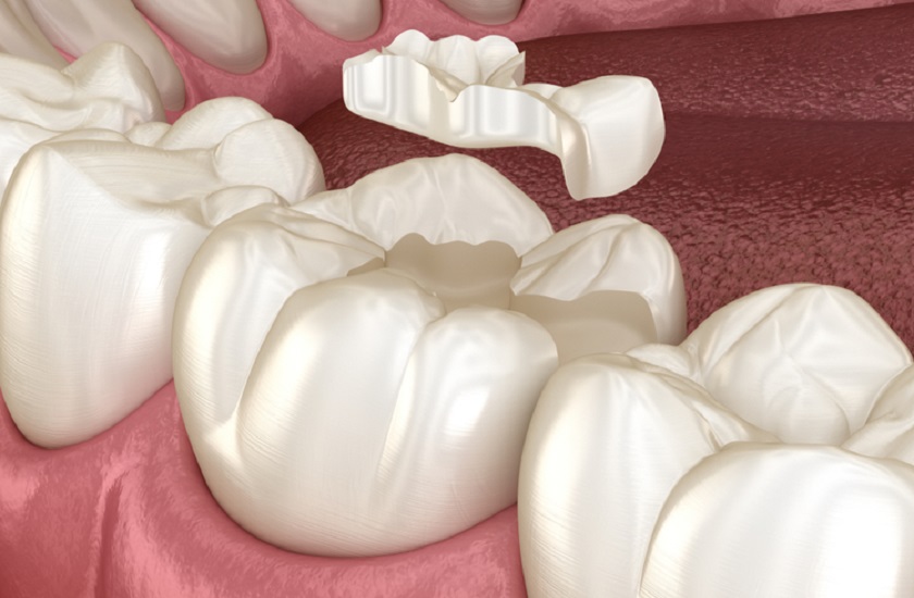 Gắn cố định miếng trám lên Tooth để hoàn thiện quy trình trám Tooth Gắn cố định miếng trám lên Tooth để hoàn thiện quy trình trám Tooth