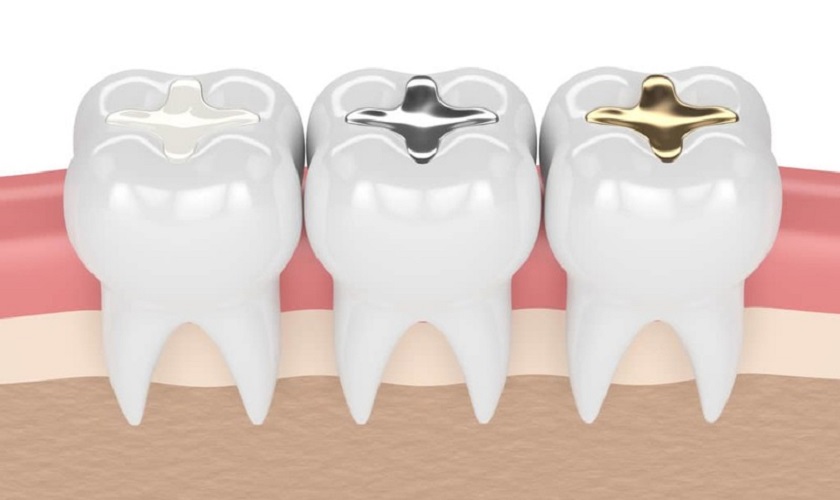 Chi phí trám Tooth thay đổi theo chất liệu trám sử dụng Chi phí trám Tooth thay đổi theo chất liệu trám sử dụng